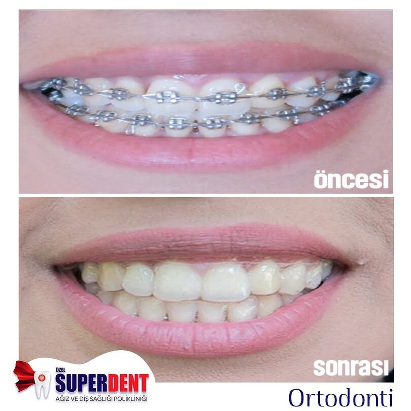 Orthodontic treatment, braces application